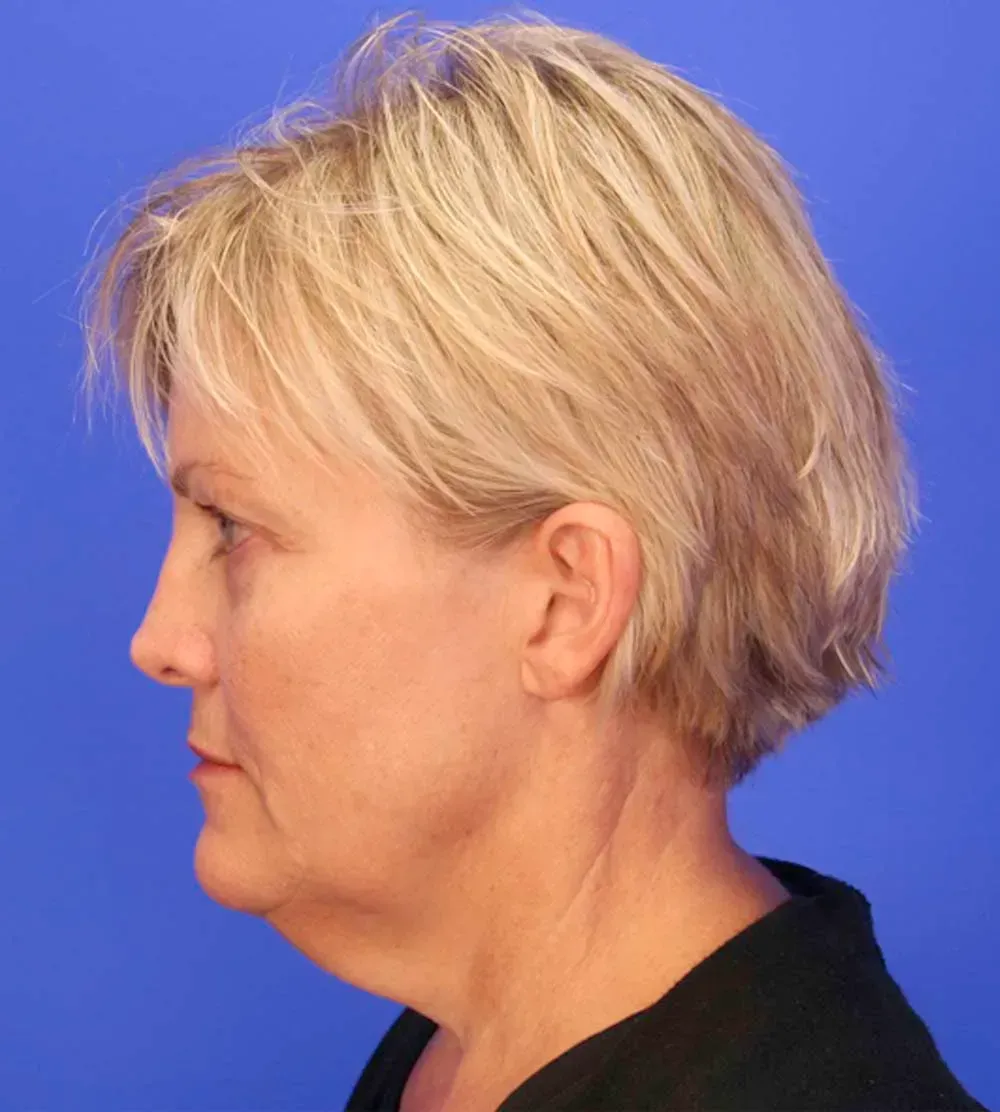 Facial Surgery