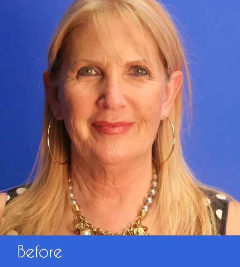 Facial Surgery