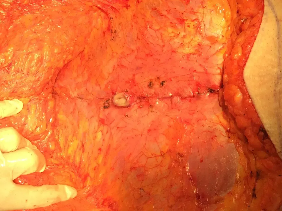 abdominoplasty cost