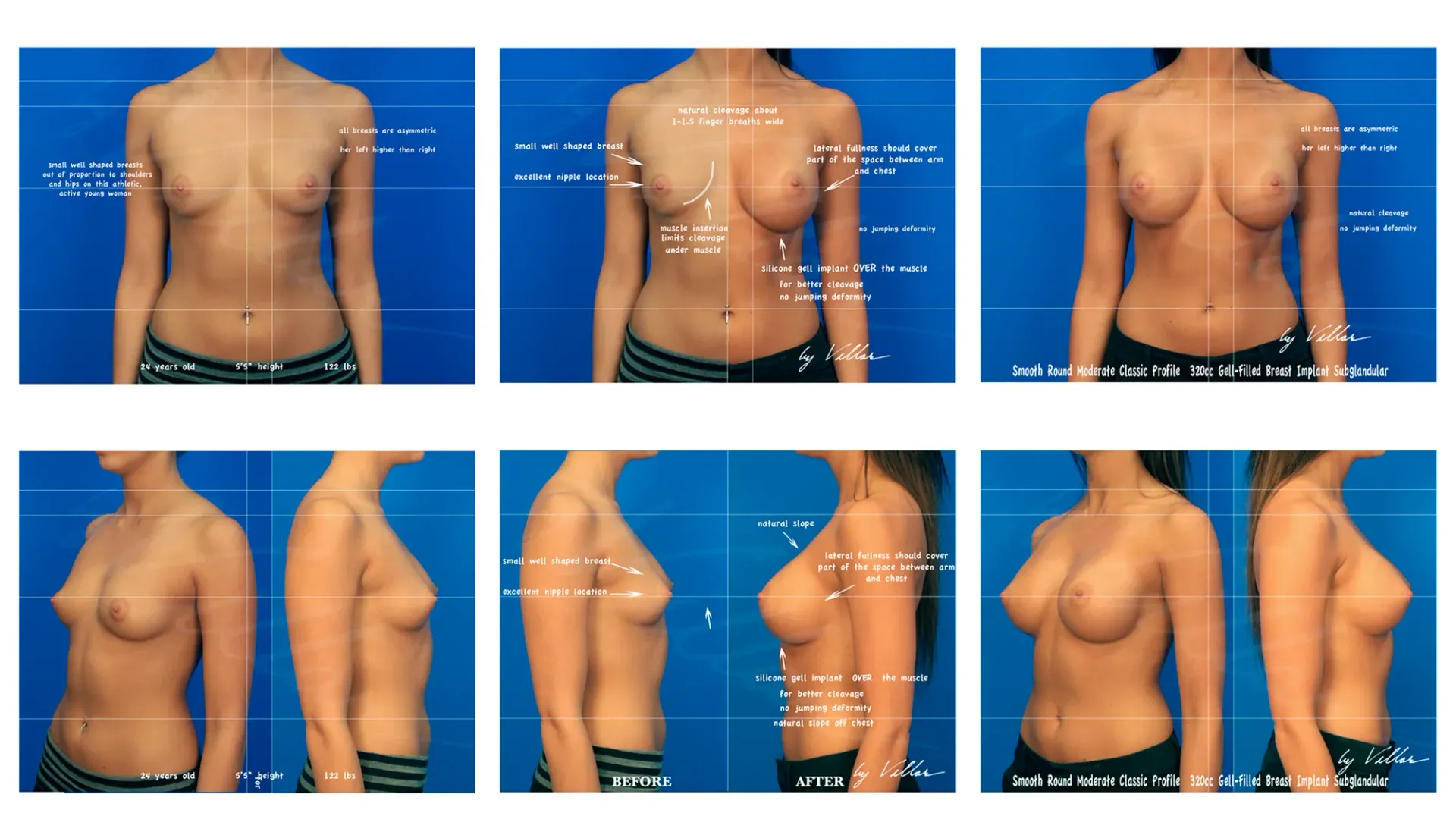 Breast Surgery