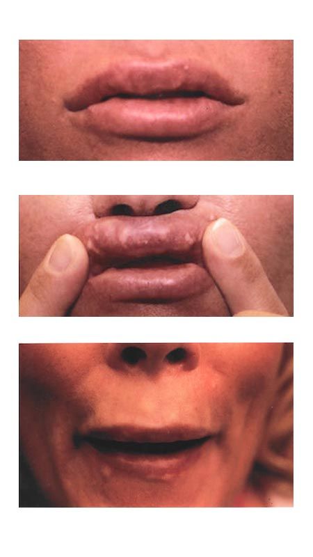botox near me