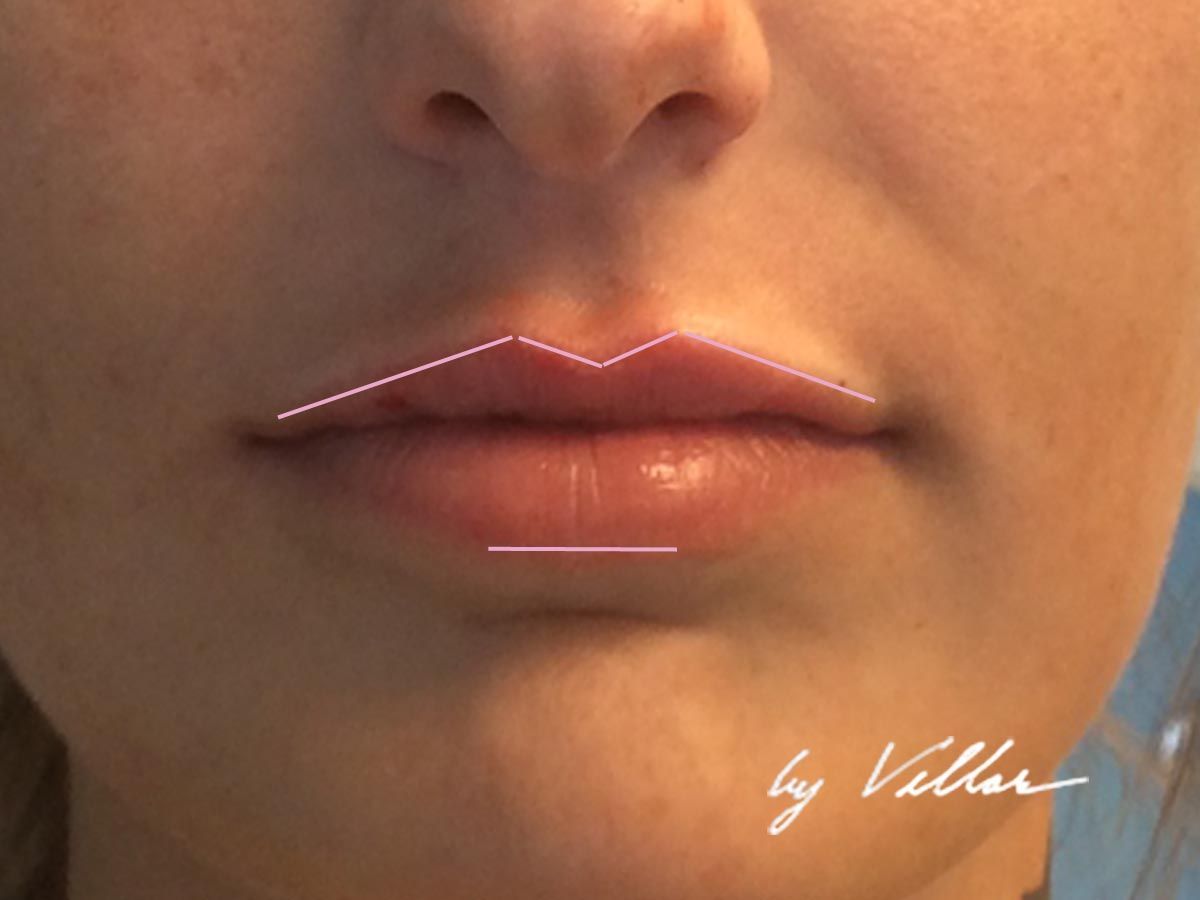 botox near me
