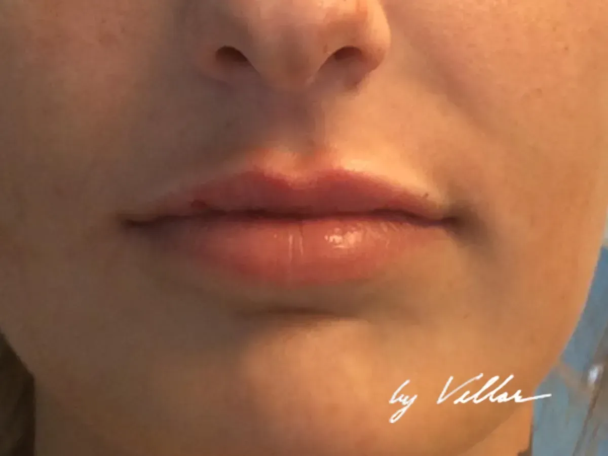 botox near me