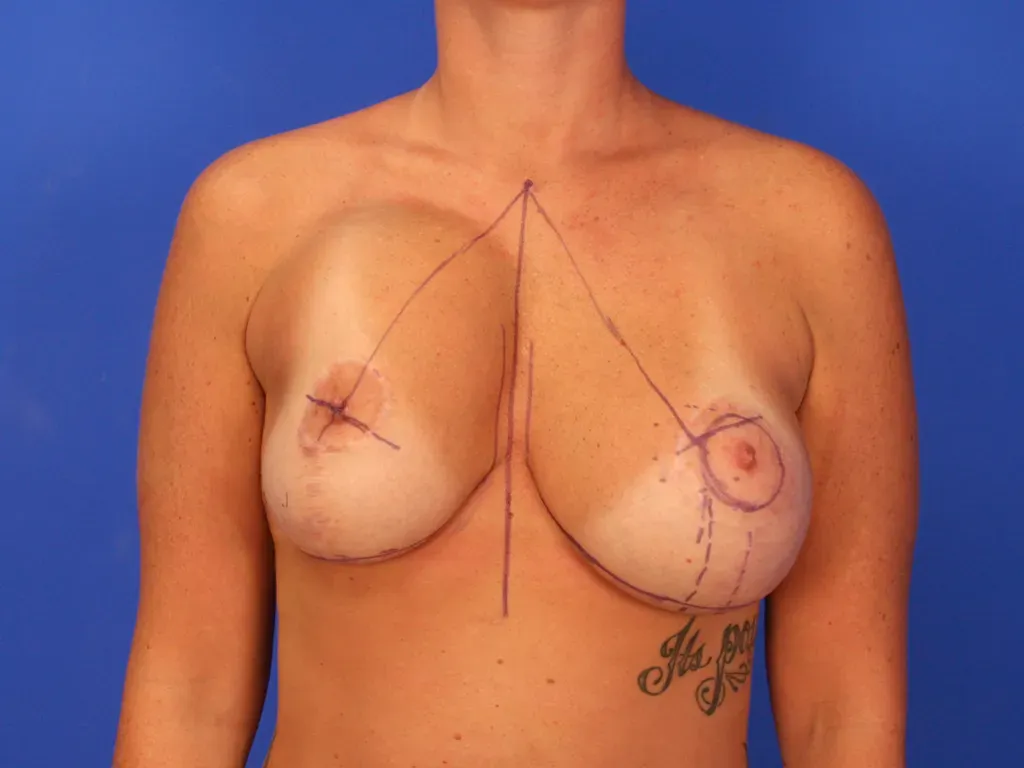 Breast Surgery