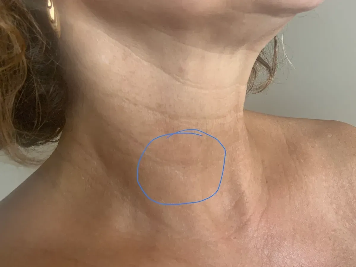 botox near me