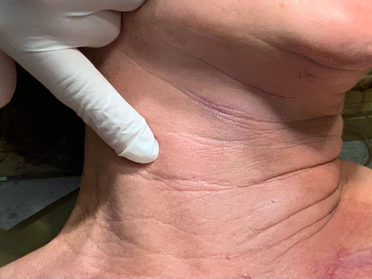 botox near me