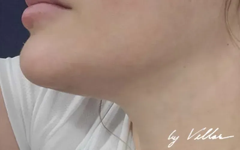 botox near me