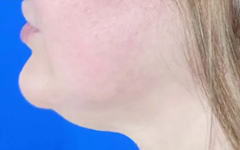botox near me