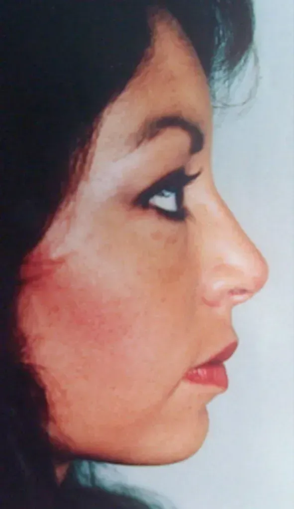 Facial Surgery