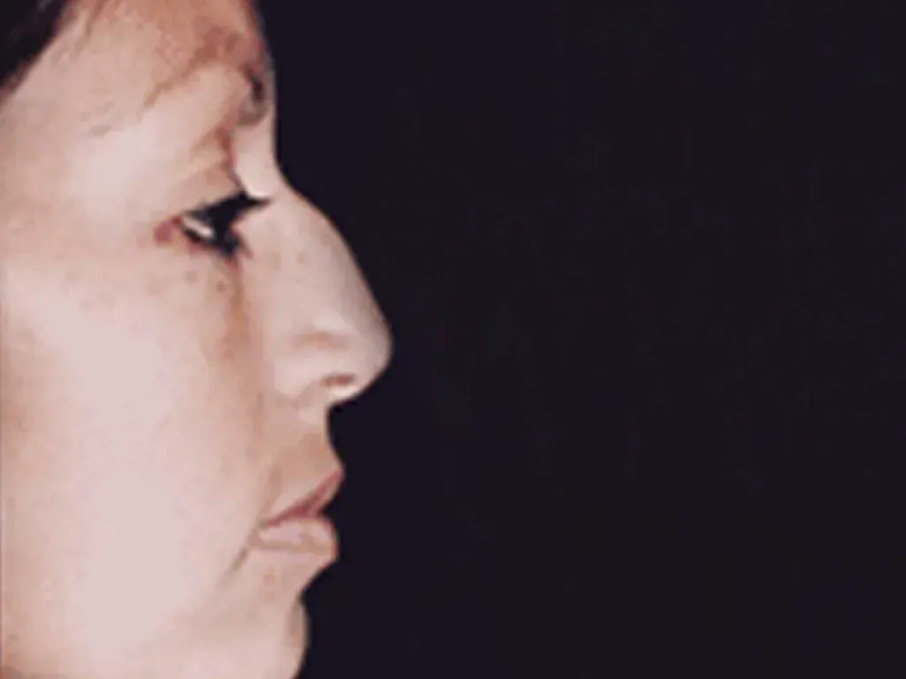 Facial Surgery