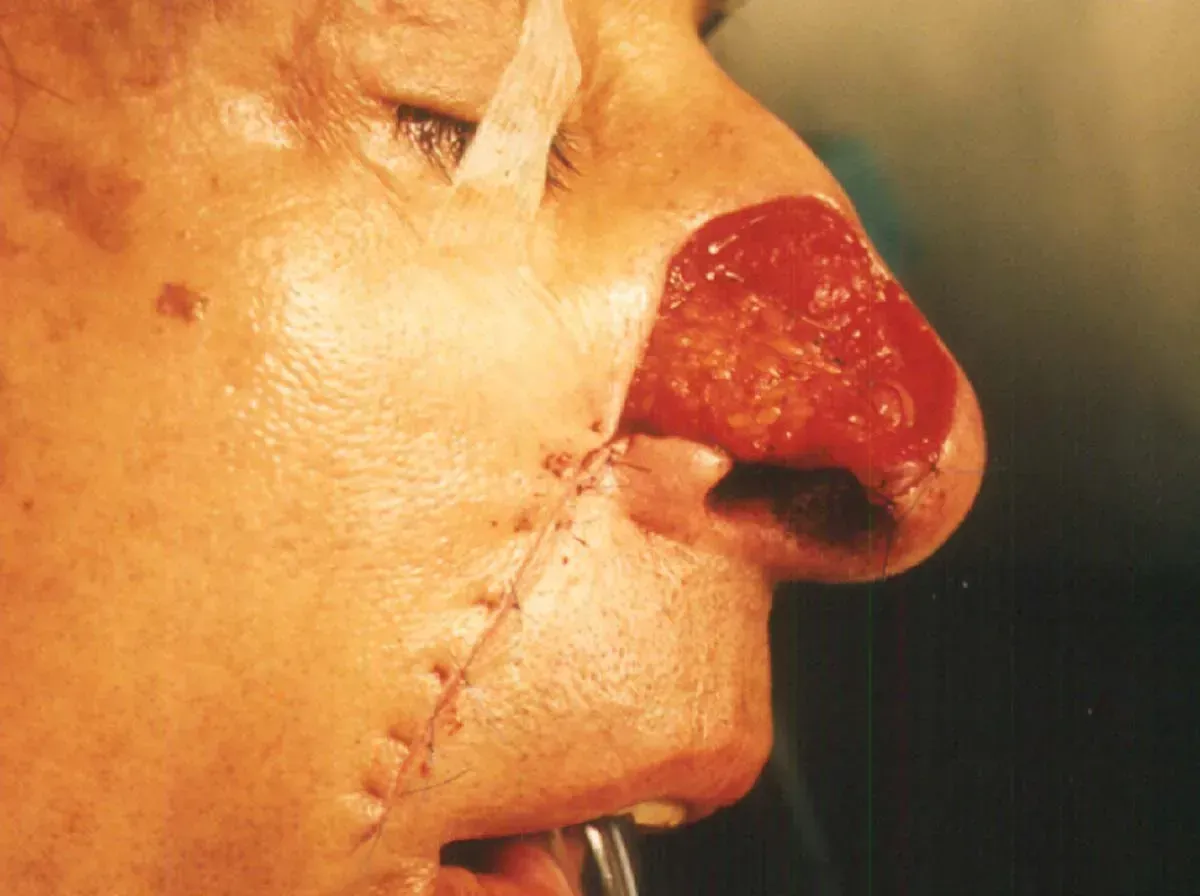 mohs procedure