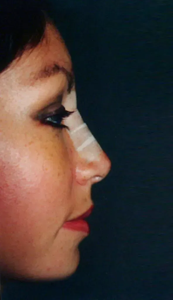 Facial Surgery