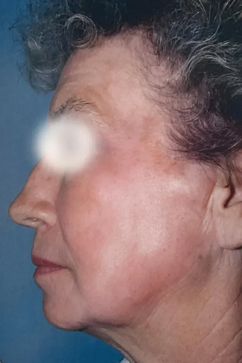 Facial Surgery