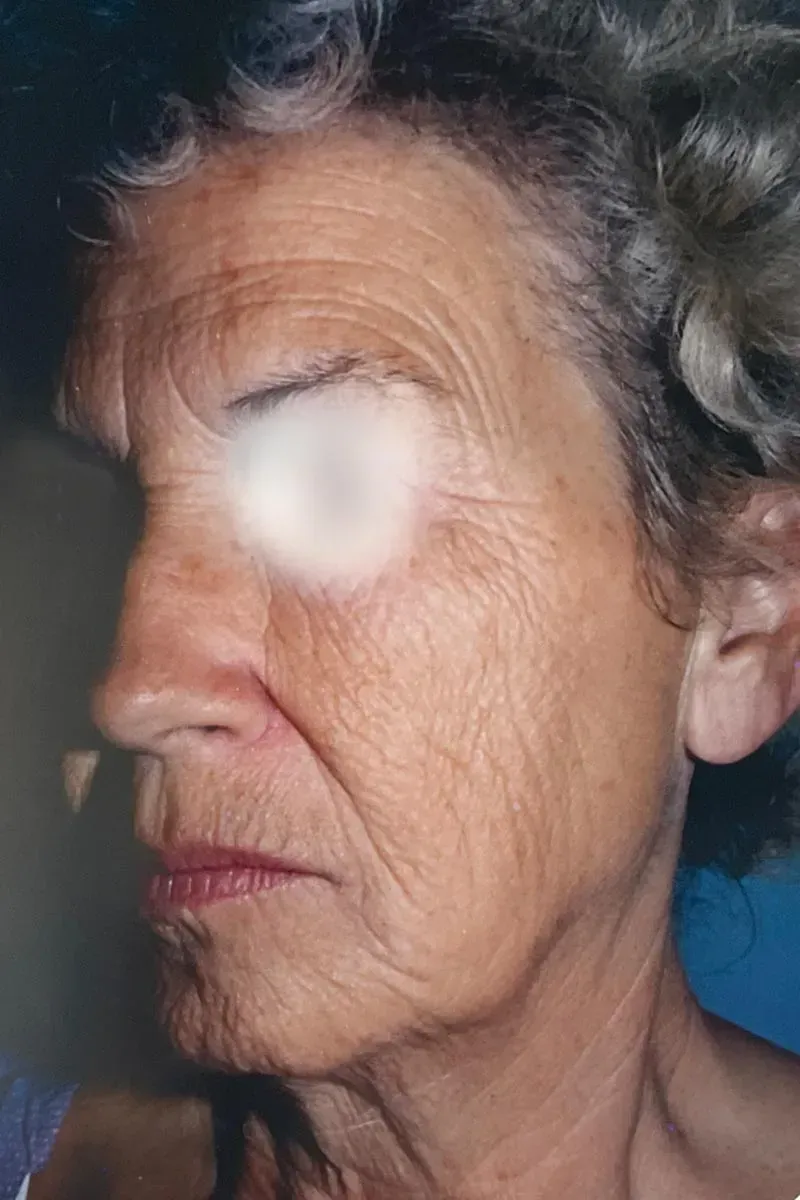 Facial Surgery