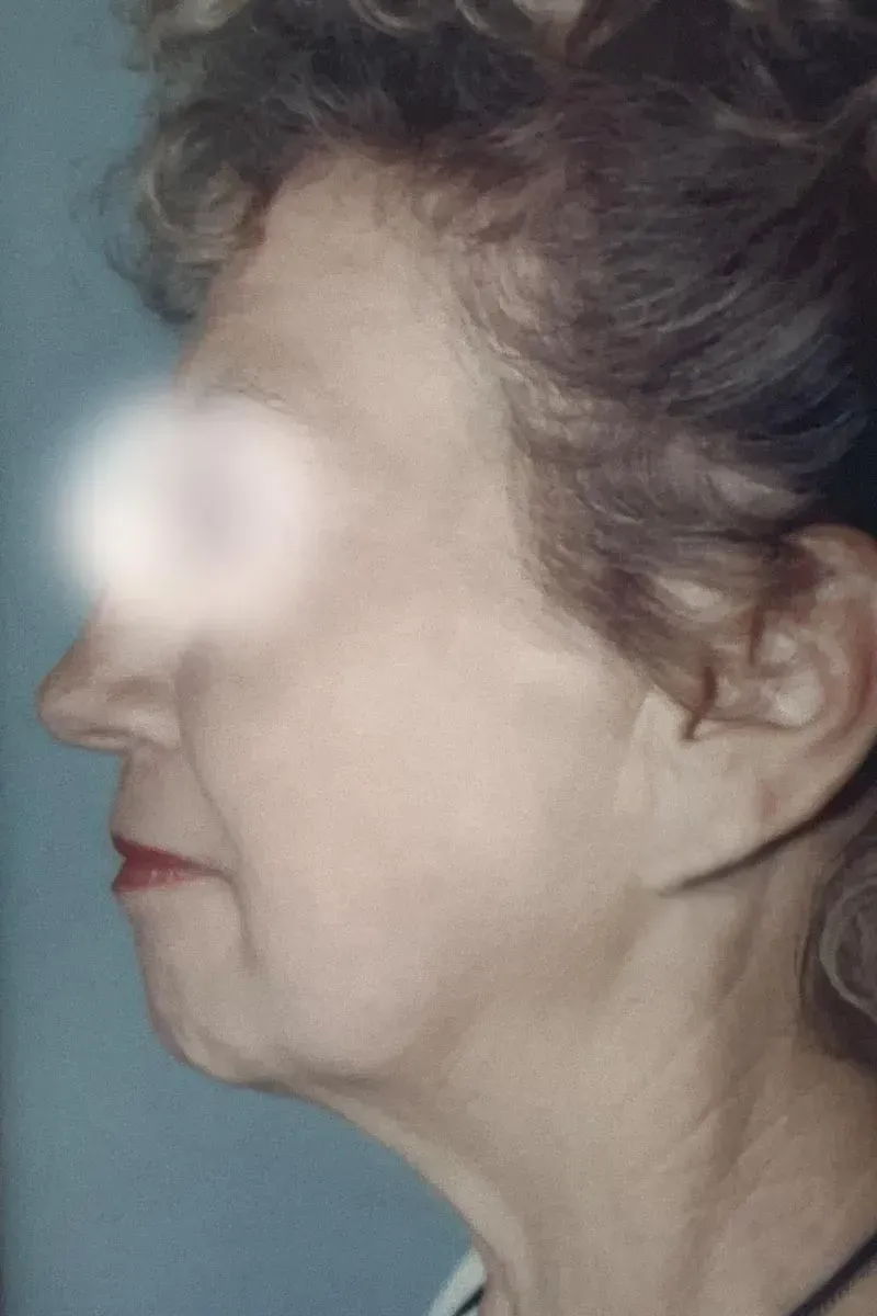 Facial Surgery