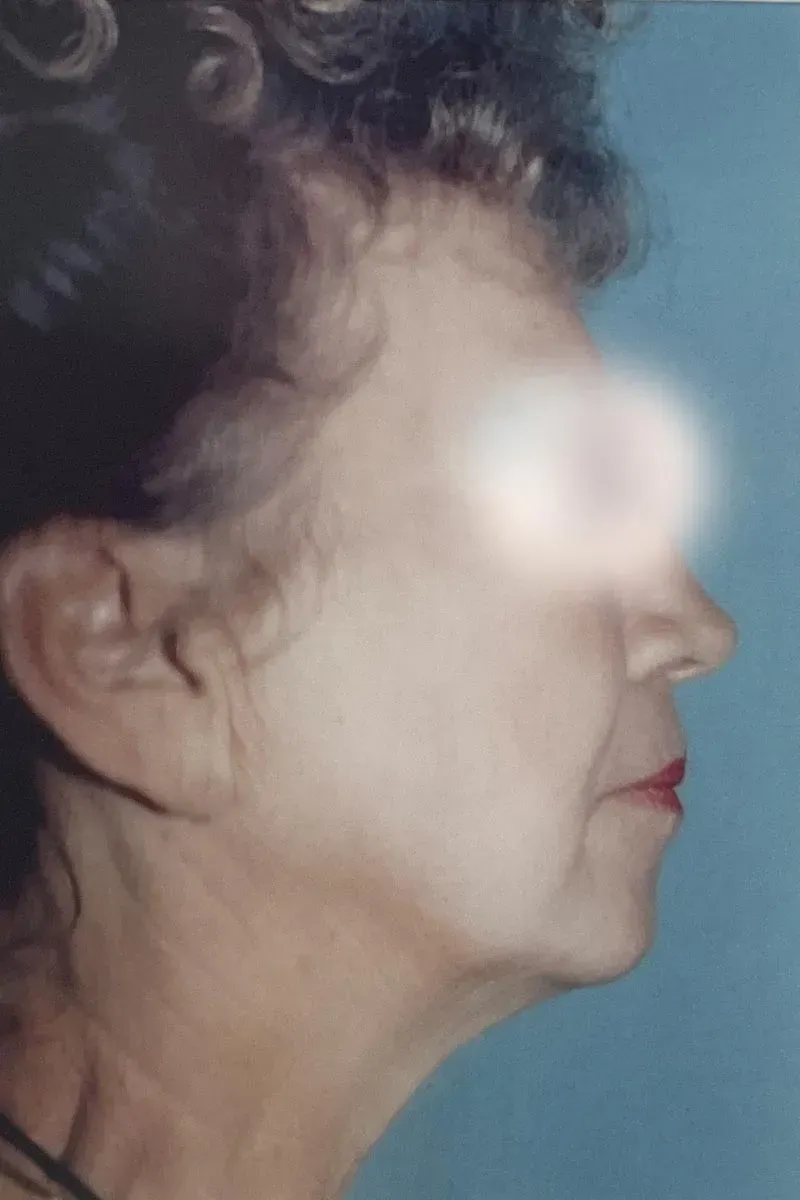 Facial Surgery