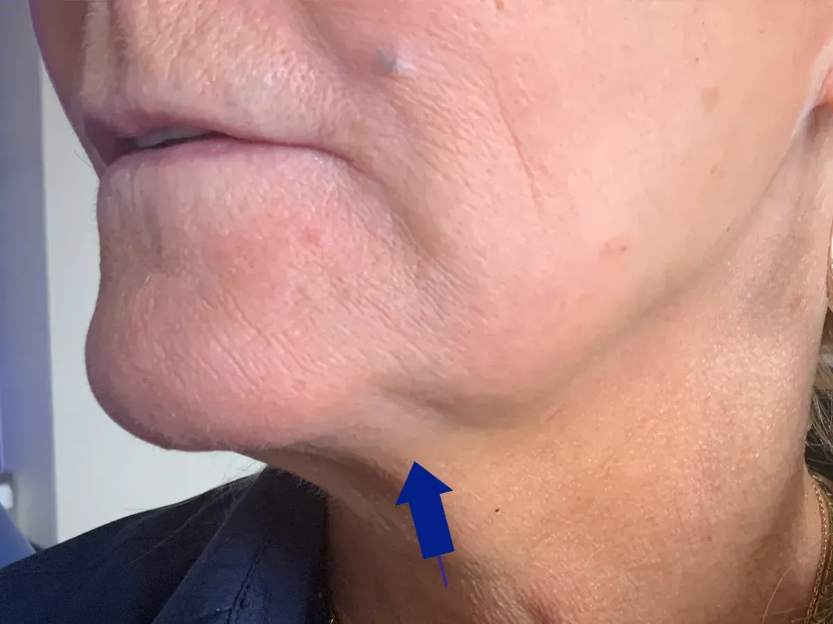 botox near me