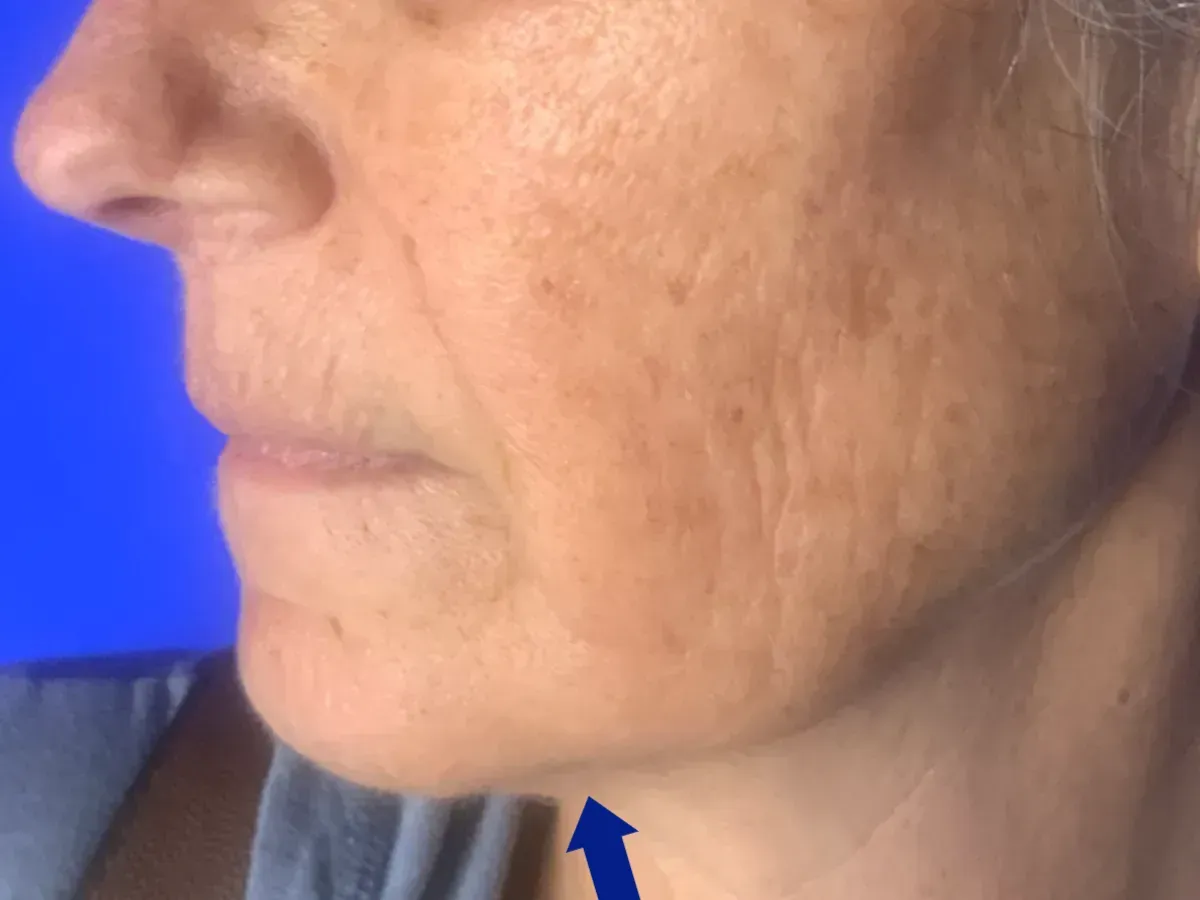 botox near me