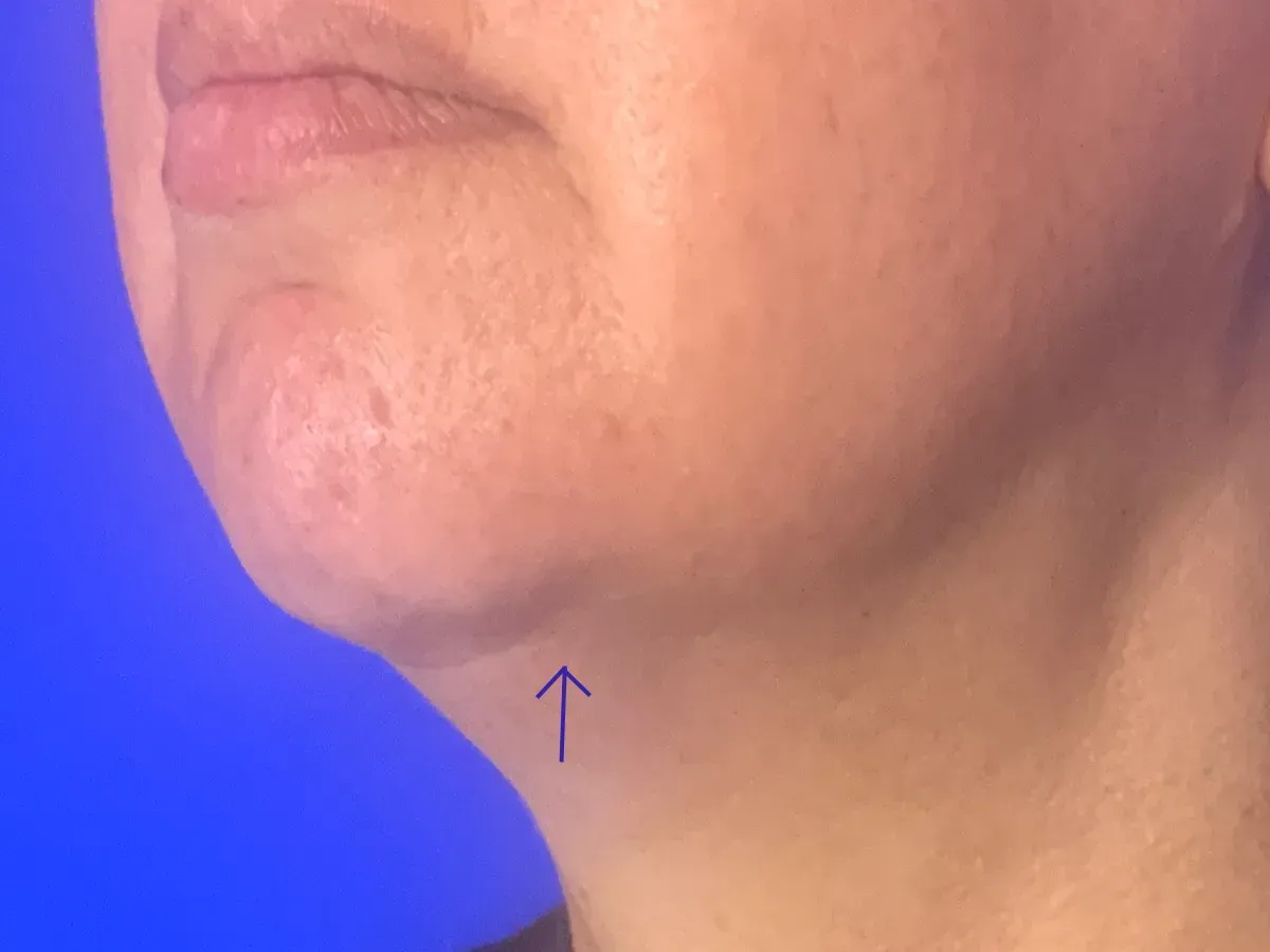 botox near me