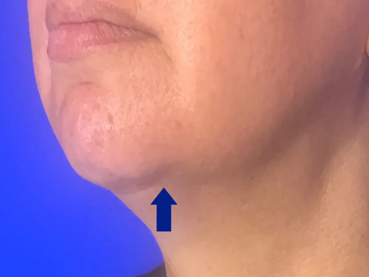 botox near me