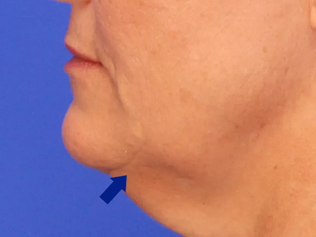 botox near me