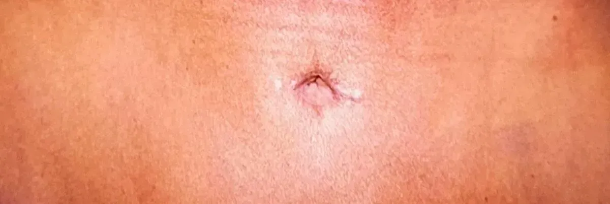 abdominoplasty cost
