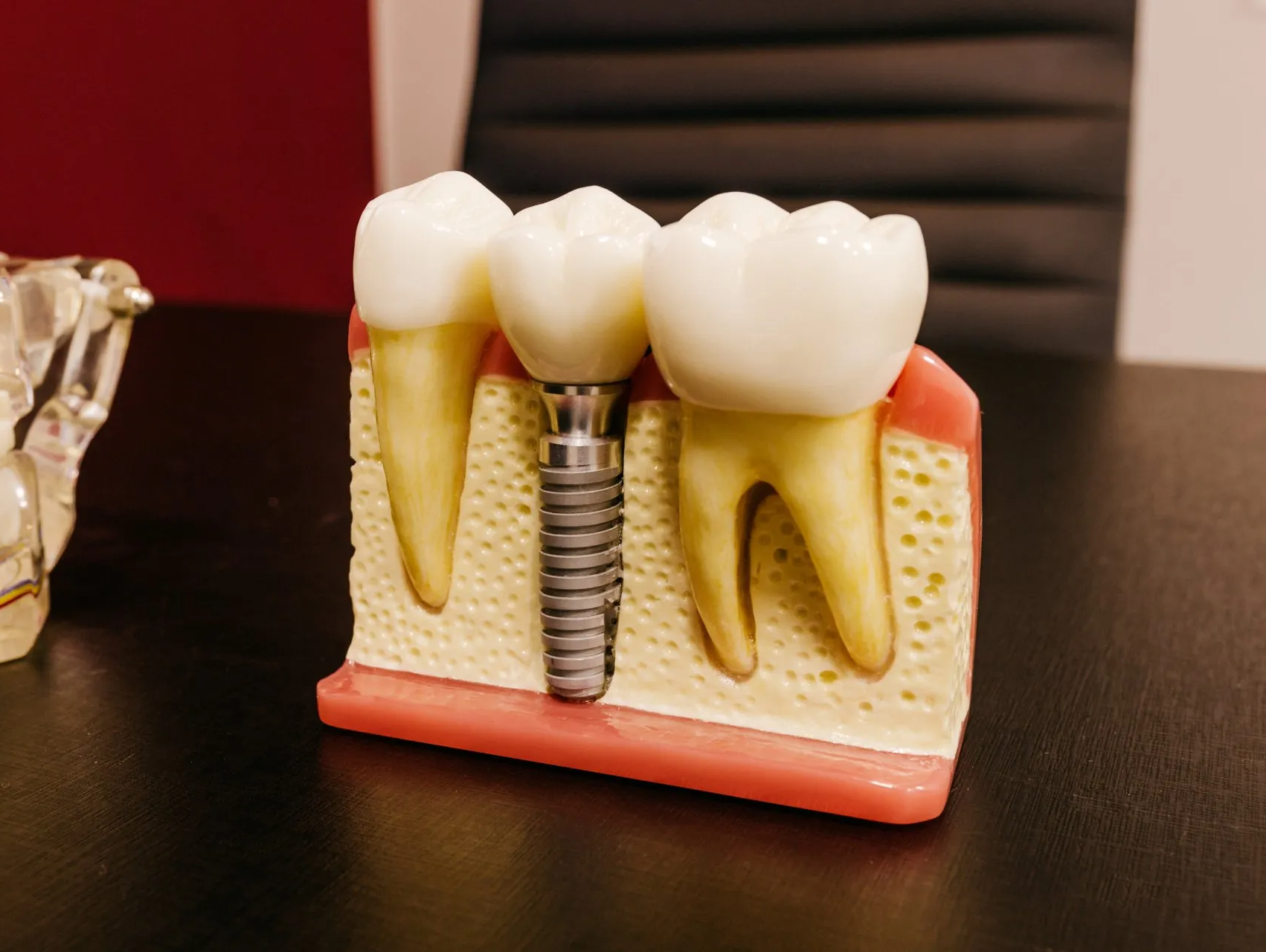 Dental Implants | Donelson Dental Center - Dental Clinic at Donelson, TN