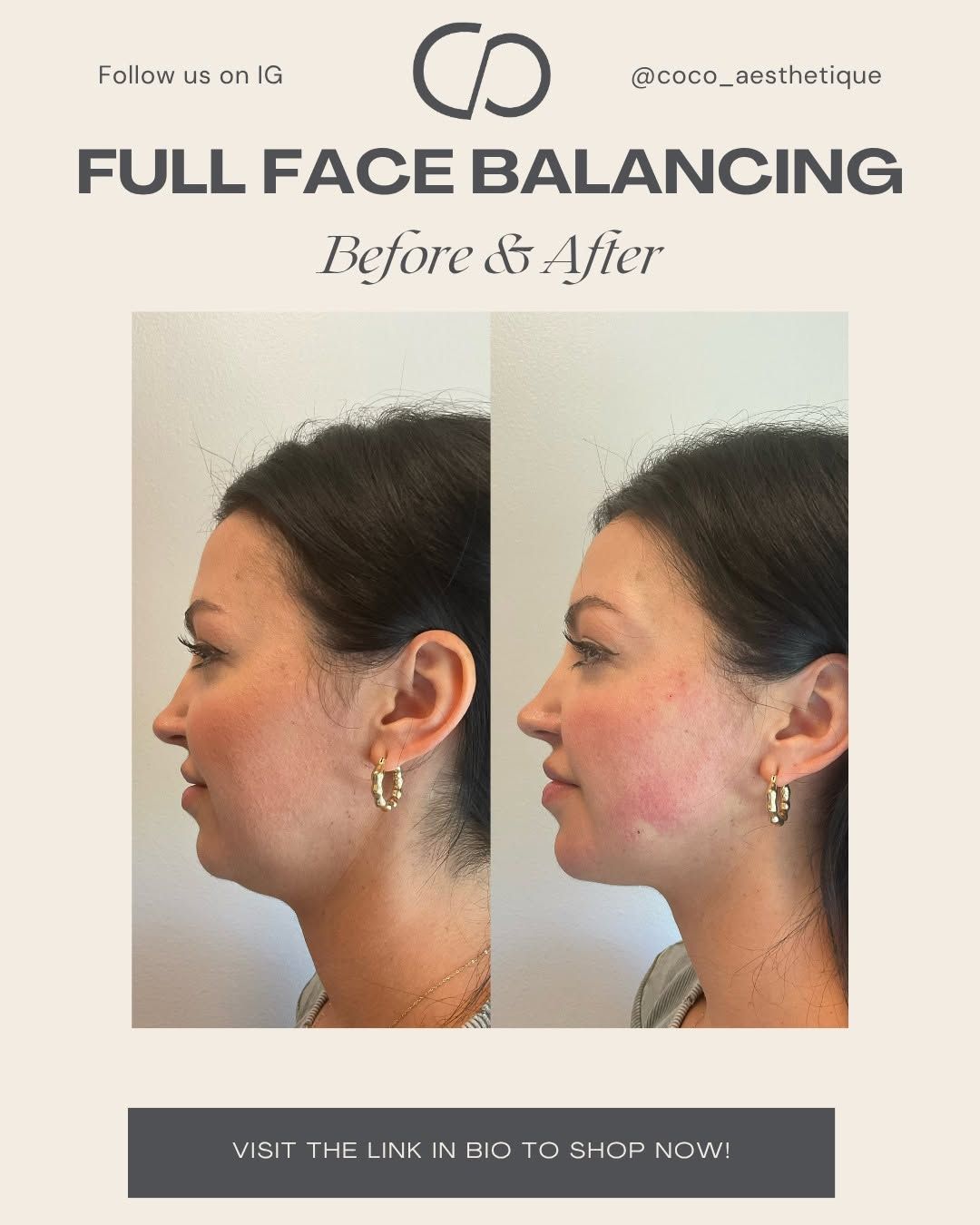 Before & After of a woman’s face, profile view. The 