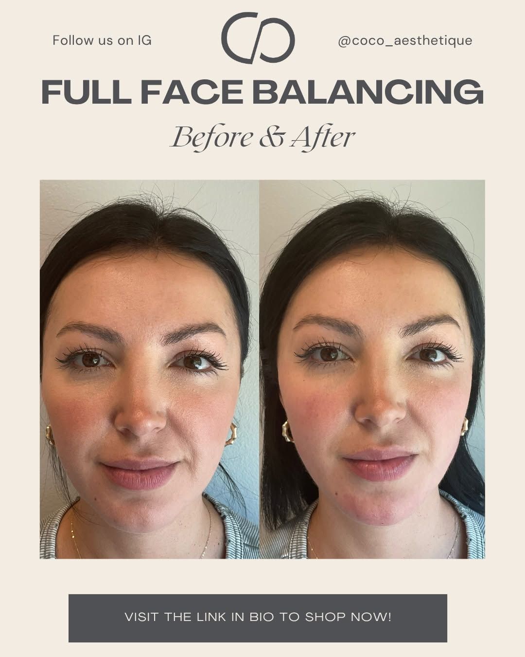 Side-by-side comparison of a woman's face before and after full face balancing, showing a more balanced and refined appearance.