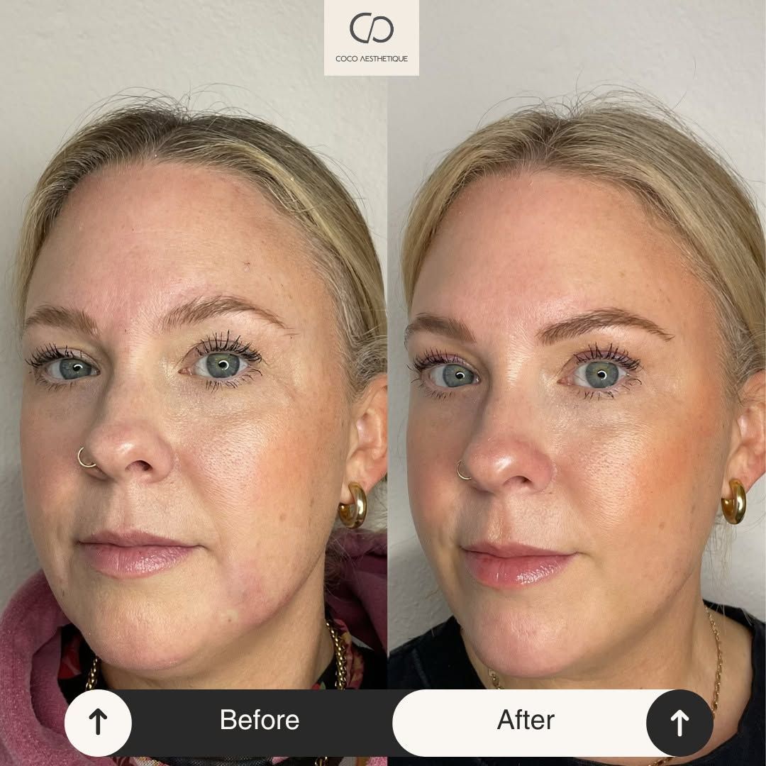 Before and after: woman's face with cosmetic work. Reduced wrinkles, enhanced skin tone, more lifted appearance.