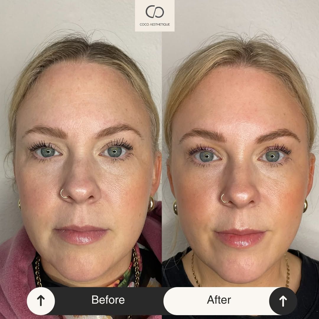 Side-by-side comparison of a woman's face: Before shows a slight downturn, After shows a refreshed look.