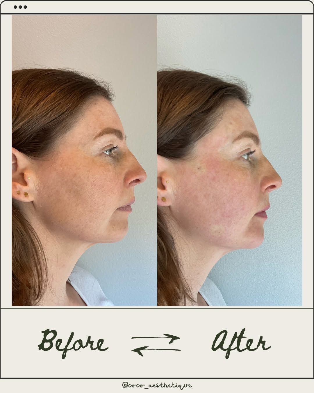 Before and after photos of a woman’s profile; after showing sharper jawline and lifted neck.