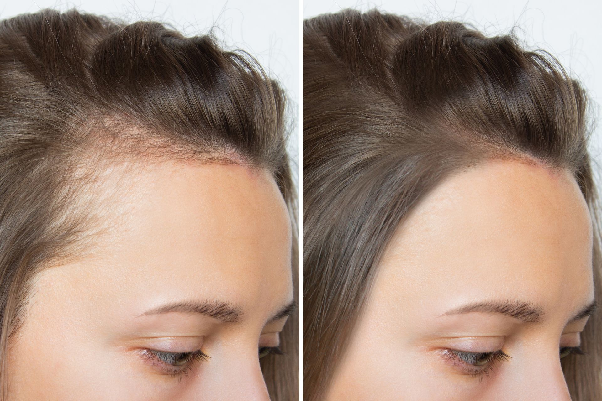 Before and after photos comparing a woman's receding hairline to a fuller hairline.