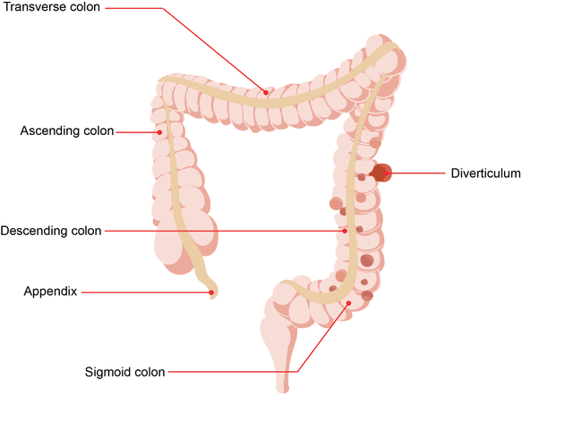 Diverticular Disease