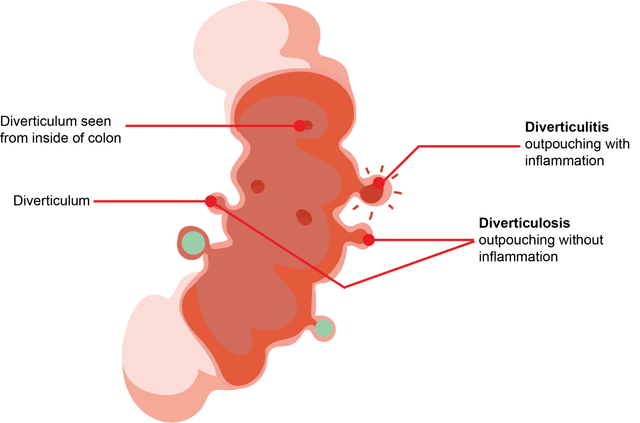 Diverticulosis versus Diverticulitis