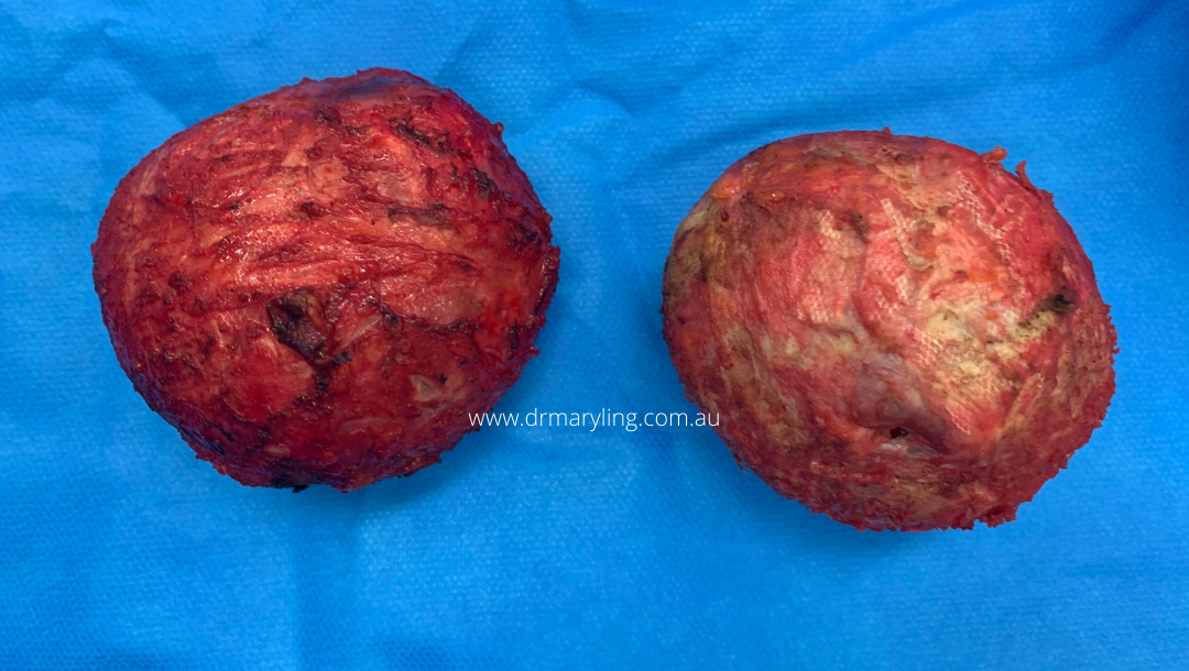 Total Intact Capsulectomy