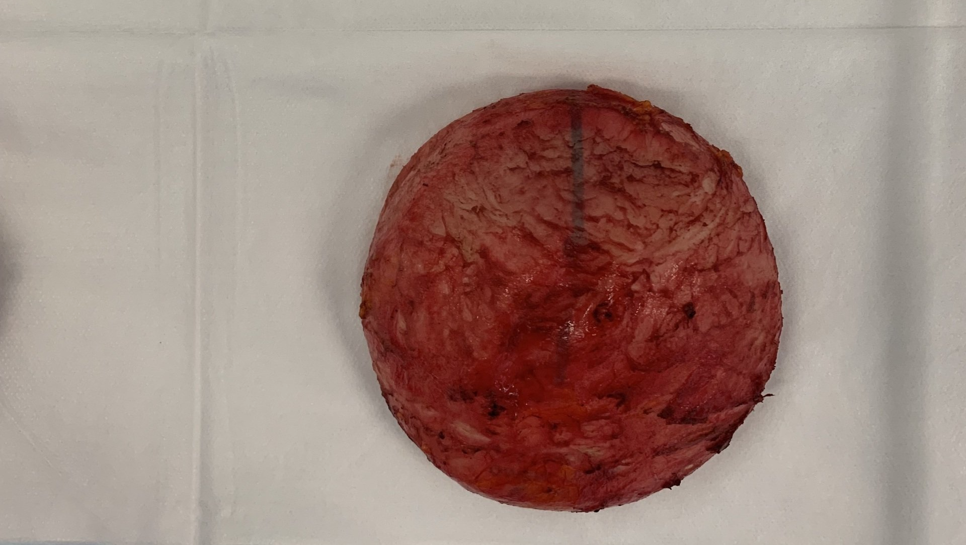 Total Capsulectomy Silimed Implant