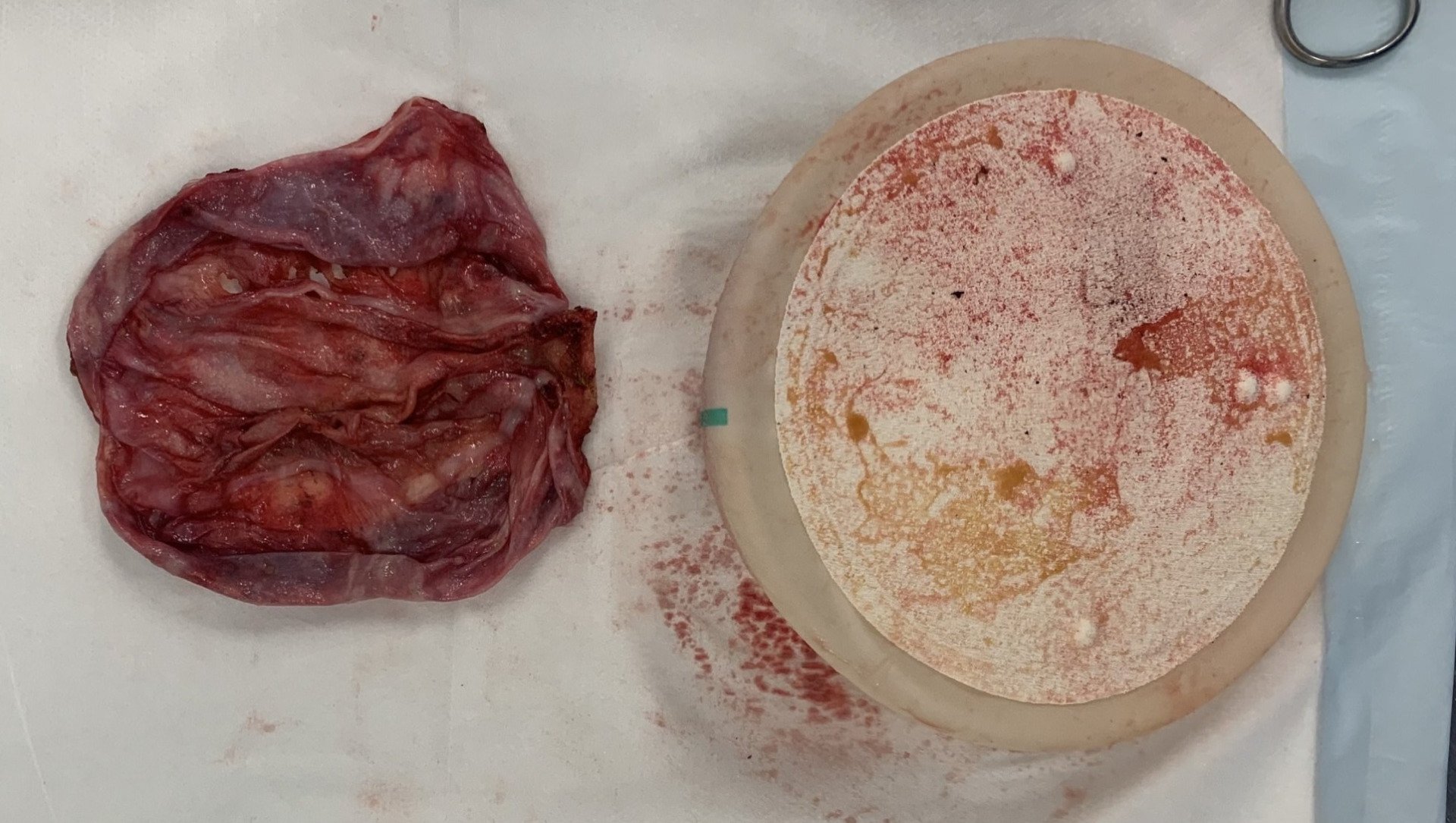 Total Capsulectomy Silimed Implant