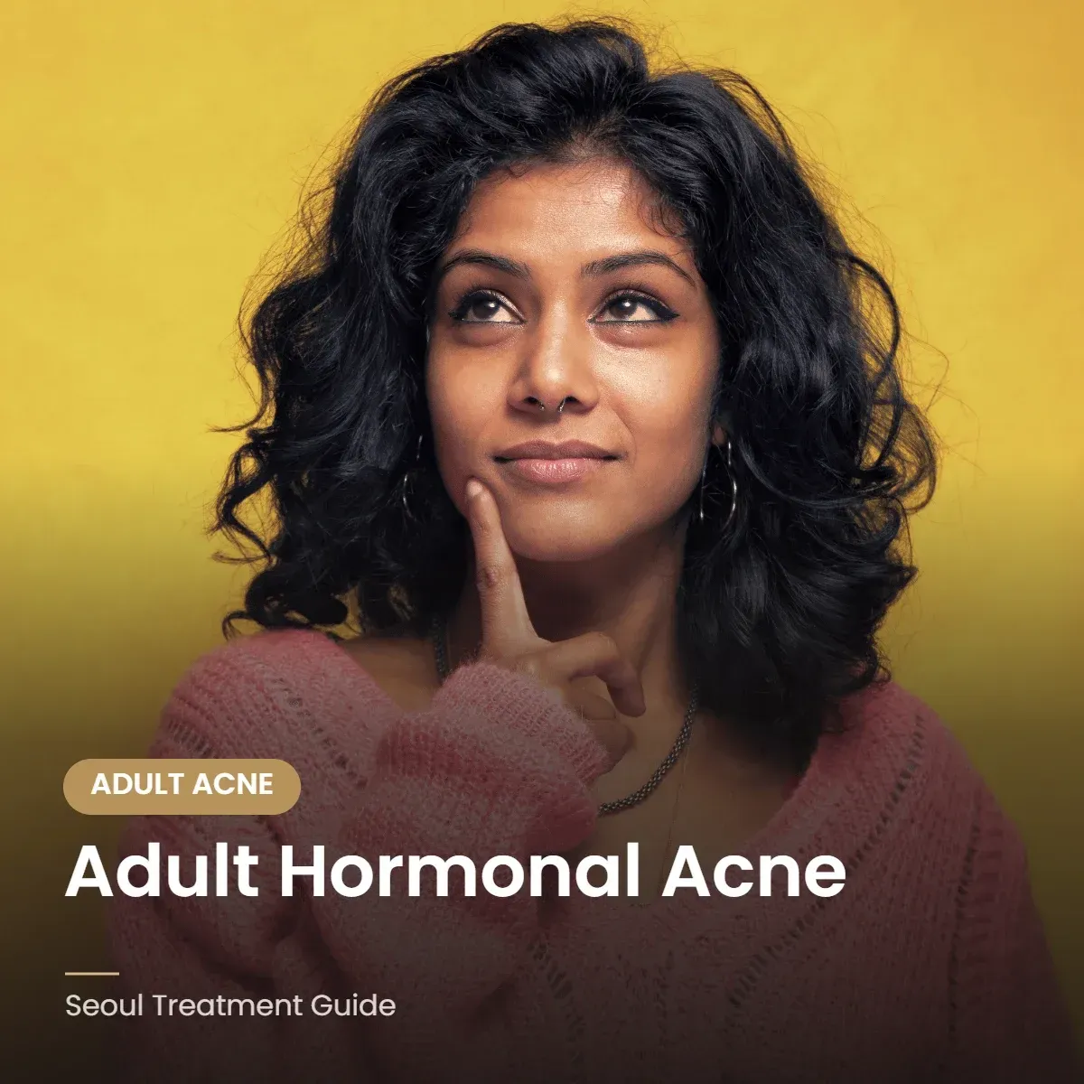 Adult hormonal acne along the jaw