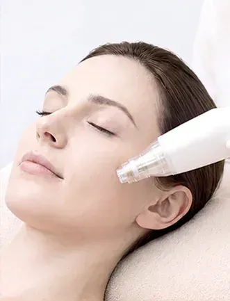RF microneedling on the cheek