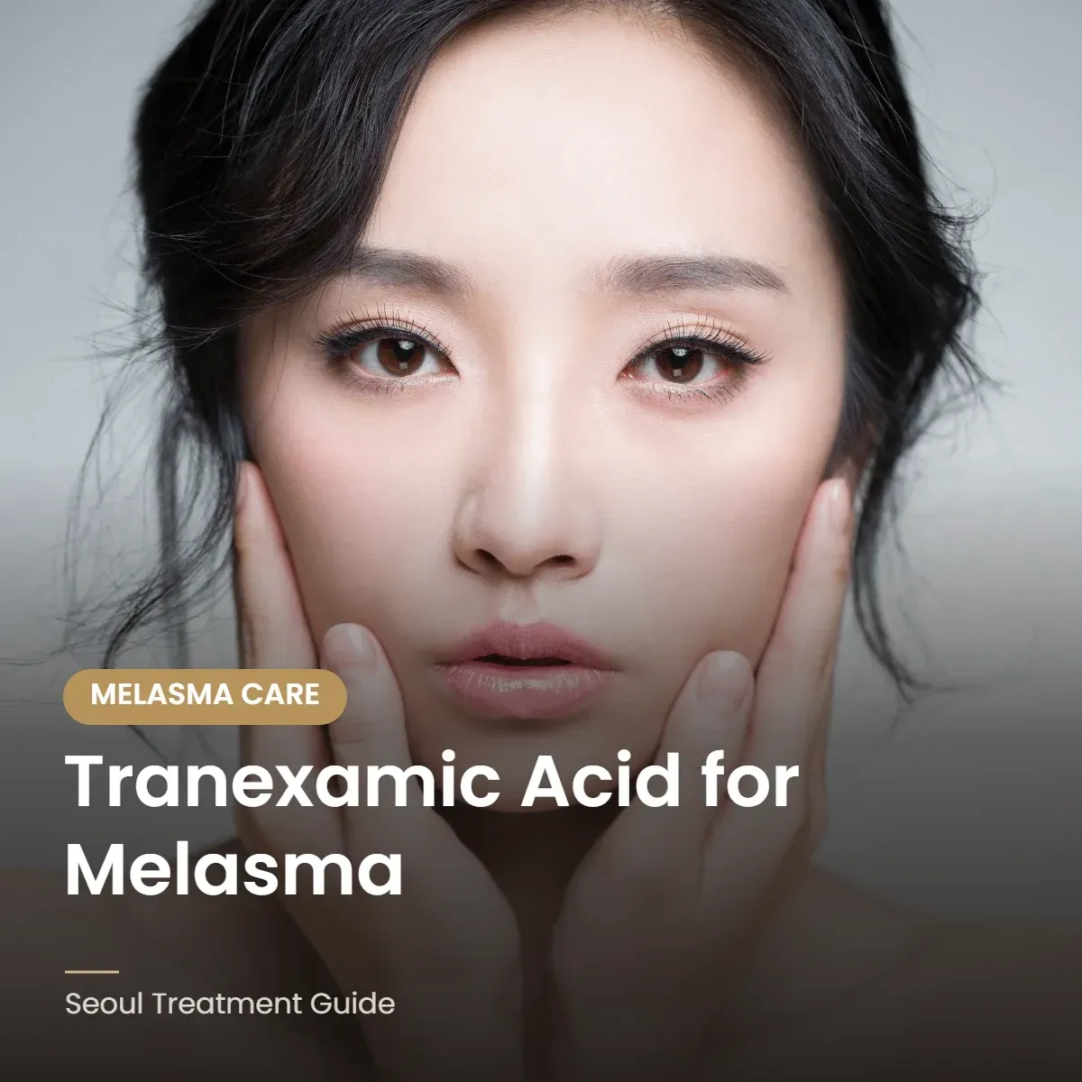 Tranexamic acid treatment for melasma