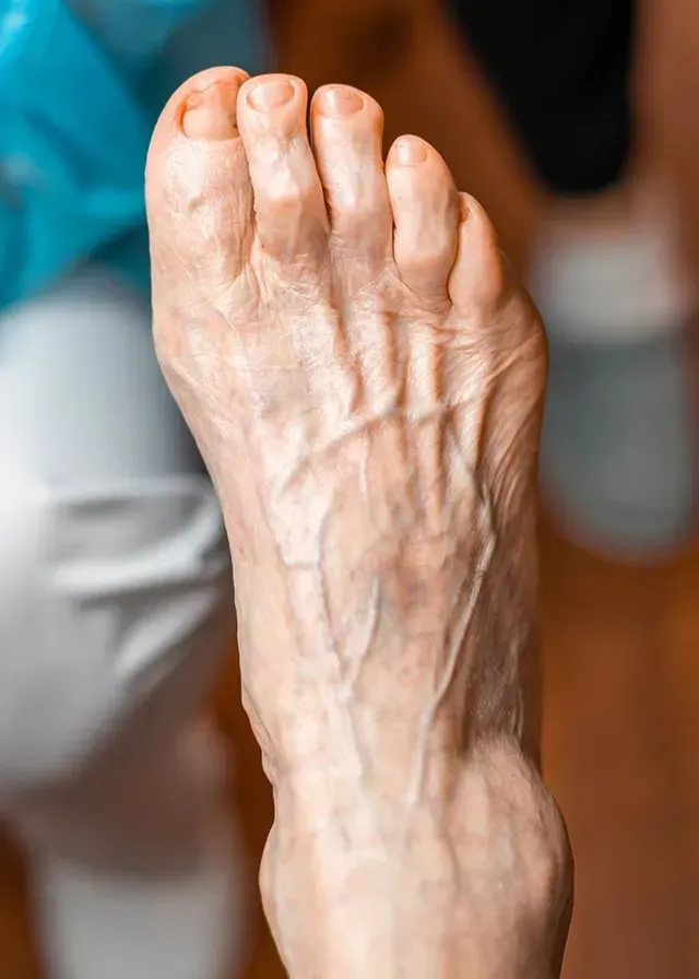 Close-up of a foot, showing prominent veins, likely an older adult.
