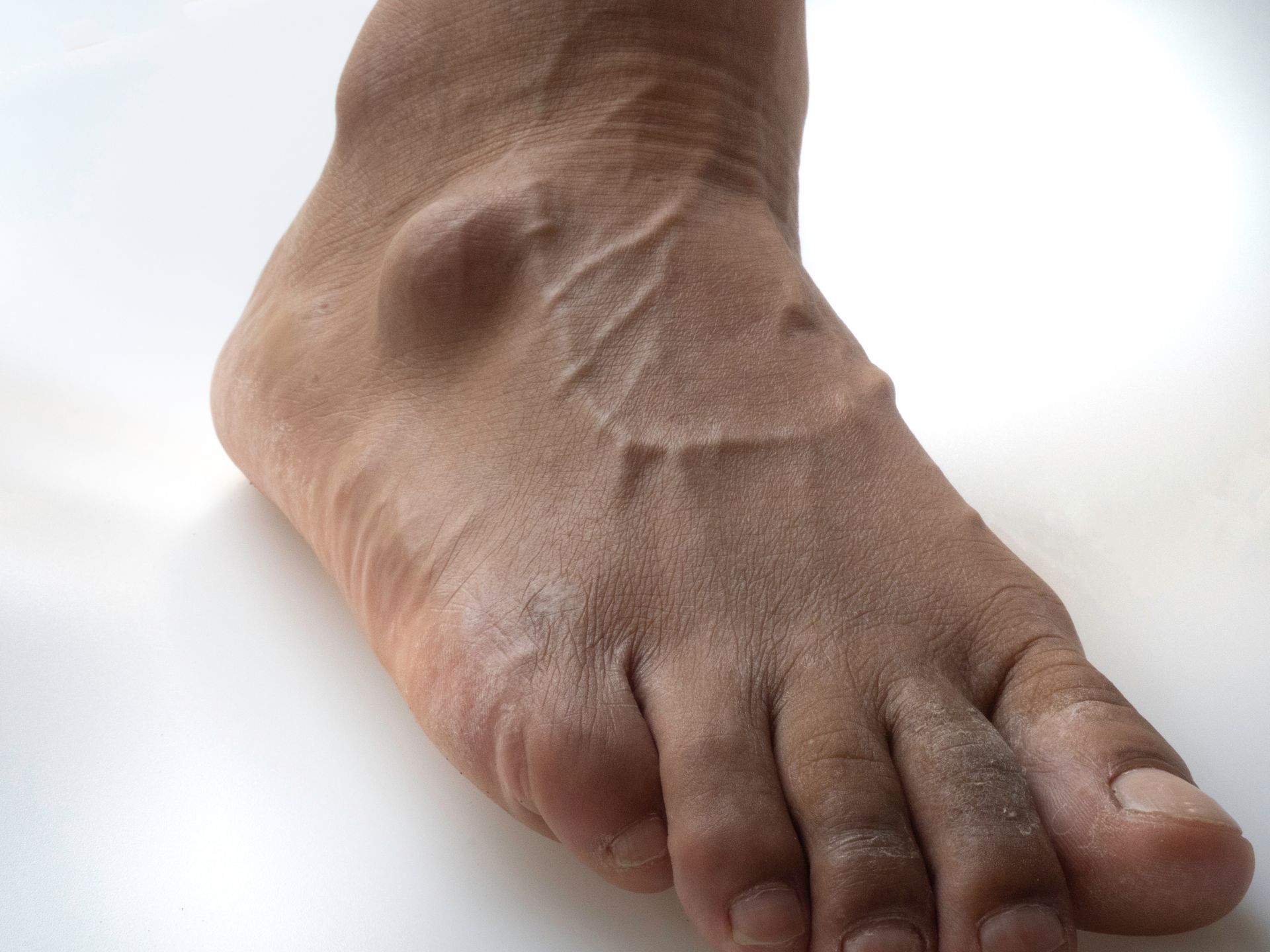 Foot with prominent veins and a bulge on the top, against a white surface.