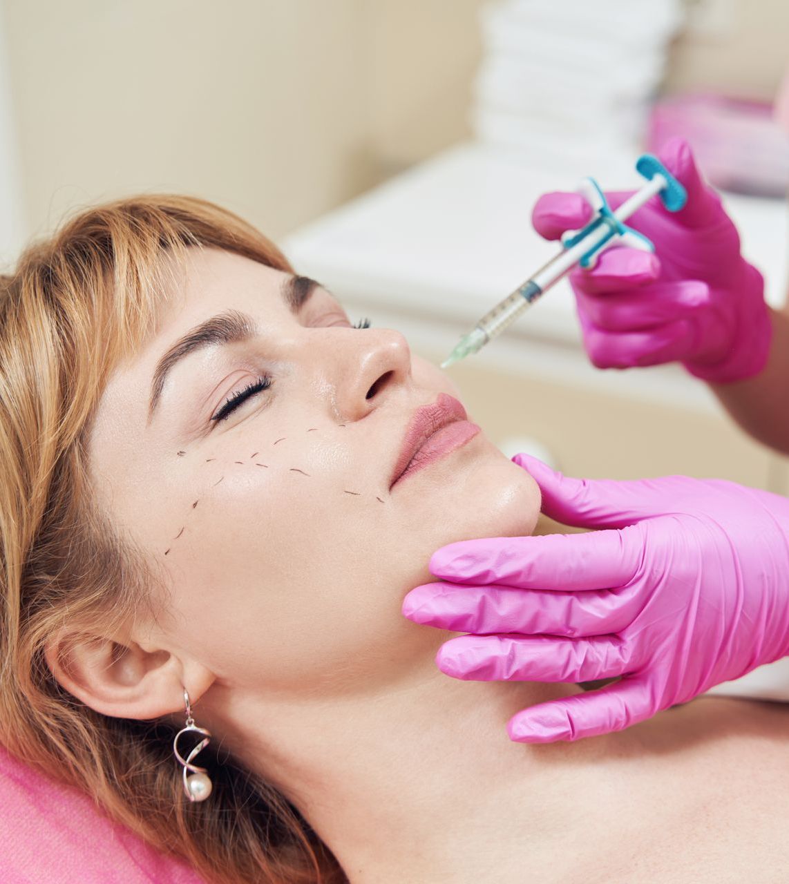 HA filler treatment