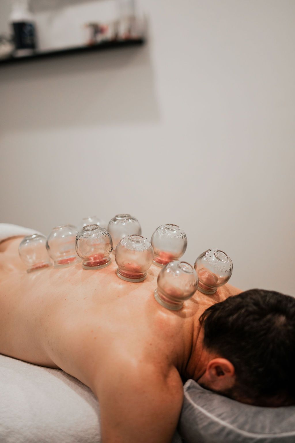 Person receiving cupping therapy on their back, with glass cups placed along the spine.