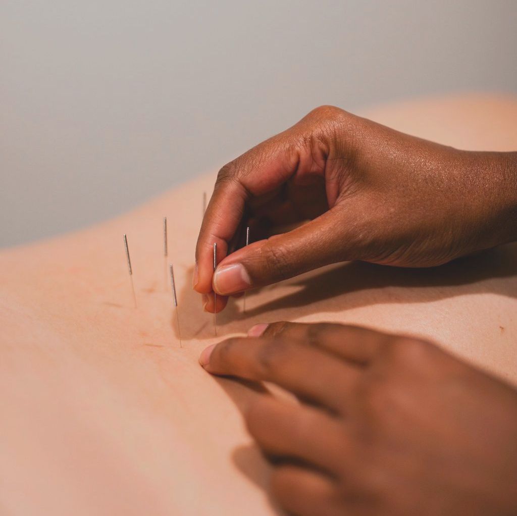 Hands placing acupuncture needles into skin on a close-up surface.