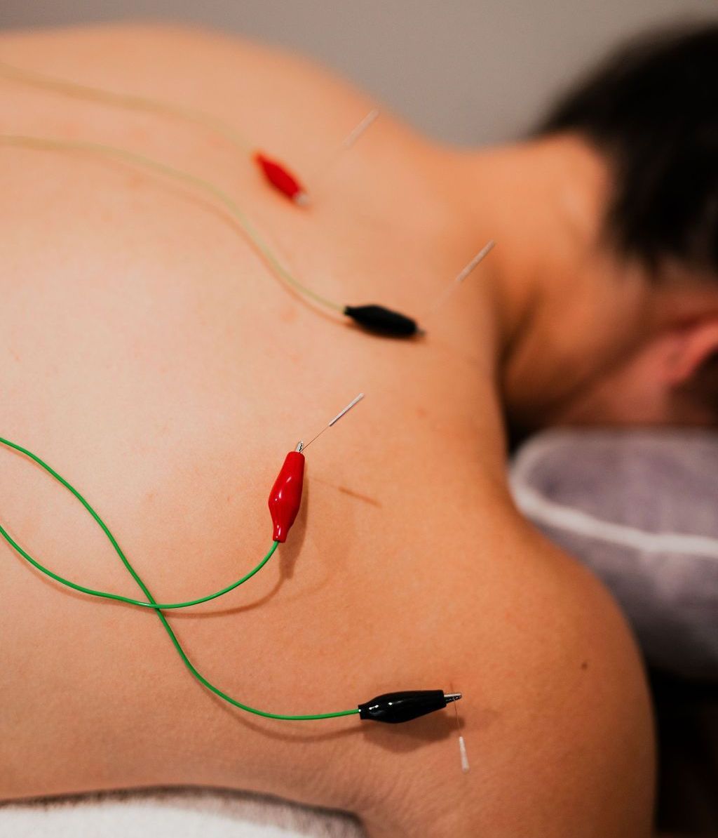 Acupuncture needles with colored wires inserted into a person’s upper back and shoulder.