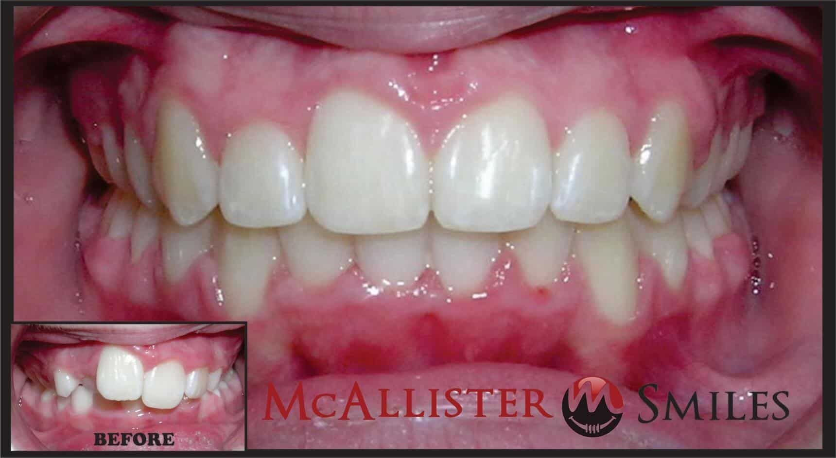 A before and after picture of a person 's teeth