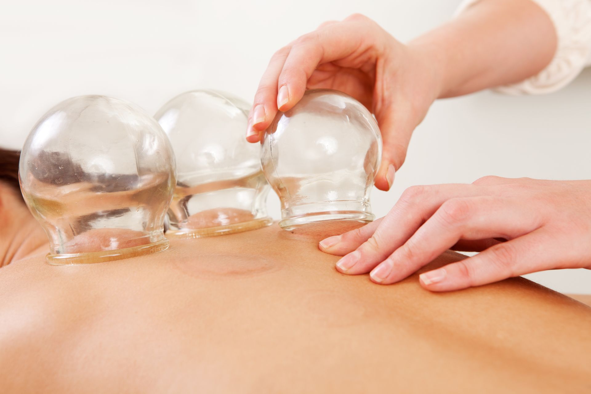 A person is getting a cupping treatment on their back.