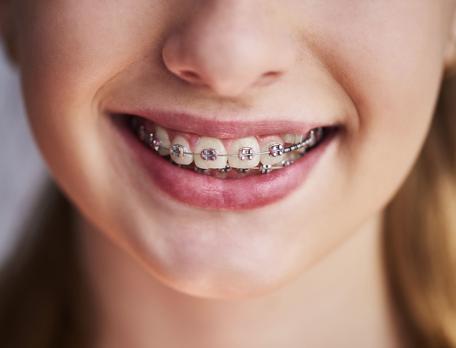 osteointegrazione degli elementi dentali